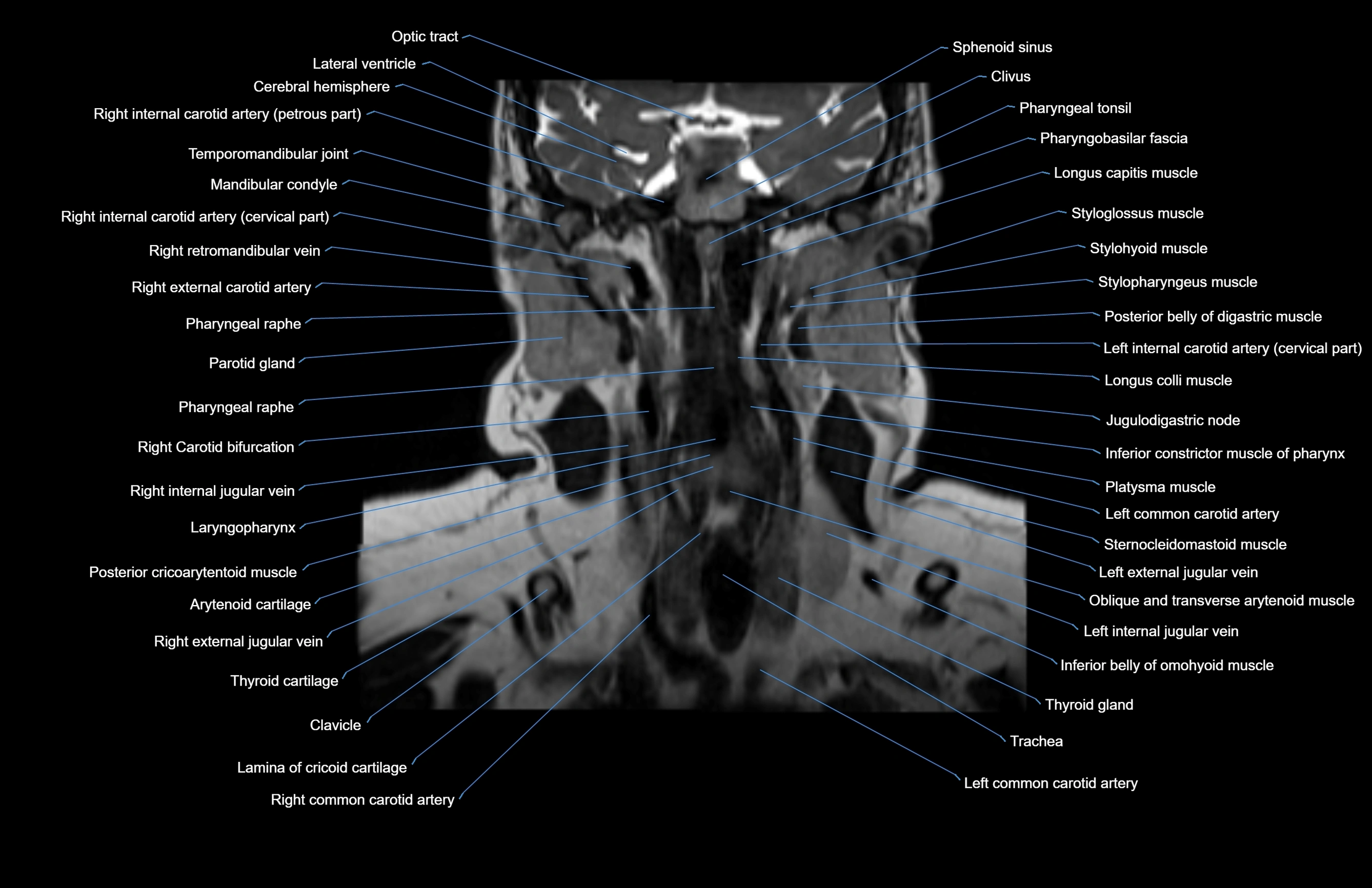 Neck coronal cross sectional MRI anatomy 3T MRI  image-img-00001-00038.webp